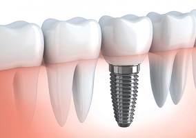 Impianto dentale implantologia impianti denti