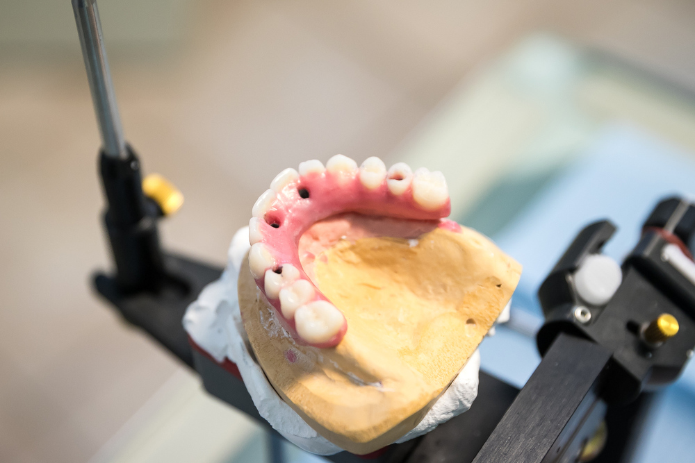 Impianti dentali  implantologia dentale